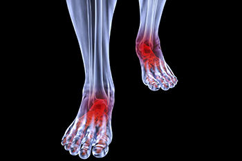 arthritic foot and ankle care treatment in the Bellaire, TX 77401 area