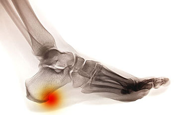 Heel spurs treatment in the Bellaire, TX 77401 area