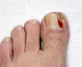 Ingrown toenails treatment in the Bellaire, TX 77401 area