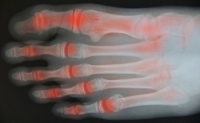 Symptoms of Rheumatoid Arthritis in the Feet and Ankles