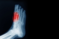 Sesamoiditis and Its Role in Ball of Foot Pain