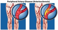 Symptoms of Peripheral Artery Disease