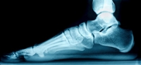 Can Flat Feet Cause Pain?